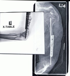 Monica Gartner's Bone X-Ray